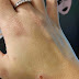 Possible Spider Bite/ Pray For Me Please