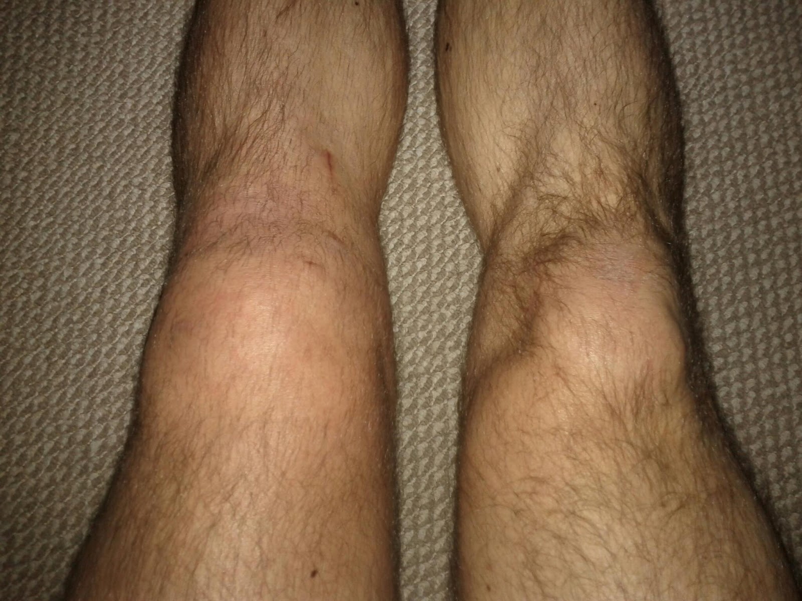 Can You Walk With A Torn Mcl Diary Of My Acl Mcl And Cartilage Injury 1 Month After Surgery