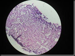 CA prostate high resolution histology slide tsnaps