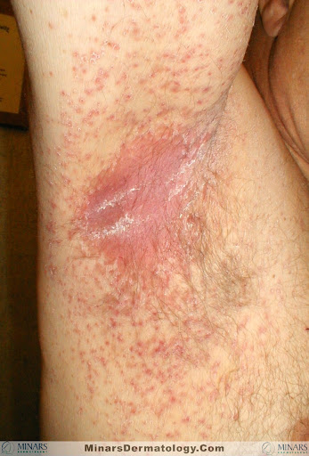 Intertrigo Candidiasis