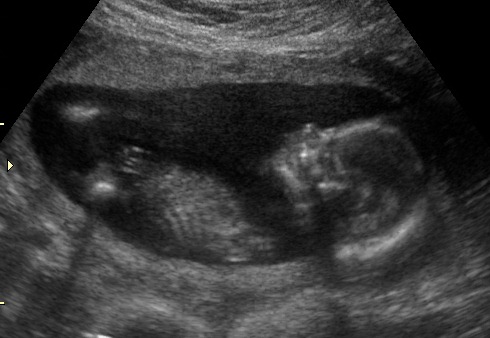 [baby%2520boy%252016%2520weeks%2520020412%2520%252818%2529%255B3%255D.jpg]