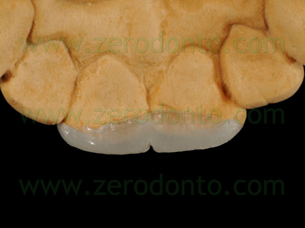 [19-mock-up-veneer3.jpg]