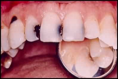 [toothdecay5.jpg]