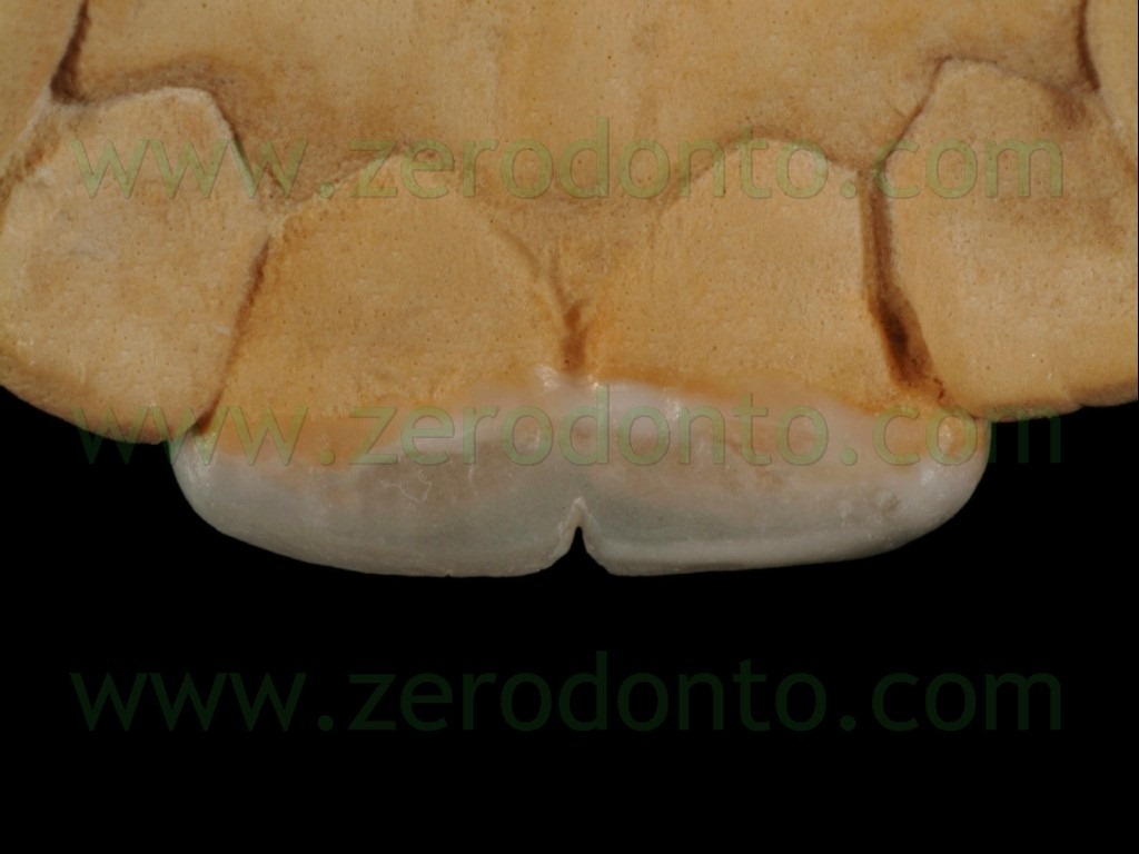 [38-faccette-usura-incisale3.jpg]