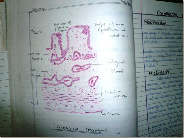 histopathology diagram hand made adeno c.a colorectal c.a