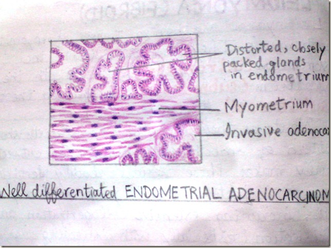 endometrial adeno carcinoma diagram histopathology