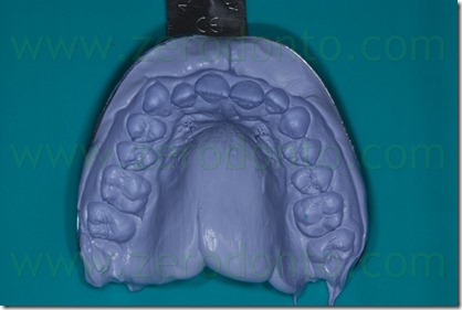 11 impronta dentale 11 impronta dentale
