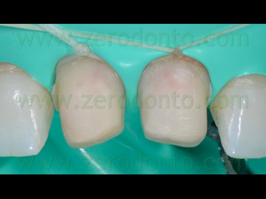 [110-digia-di-gomma-veneers3.jpg]
