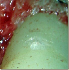 Up close resorptive defect prepped022