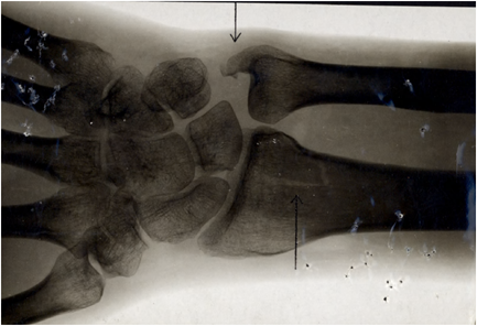 Crawford-wrsit-X-RAY Crawford-wrsit-X-RAY