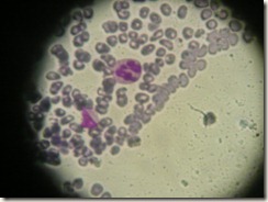 macrocytic anemia photograph f histology slide