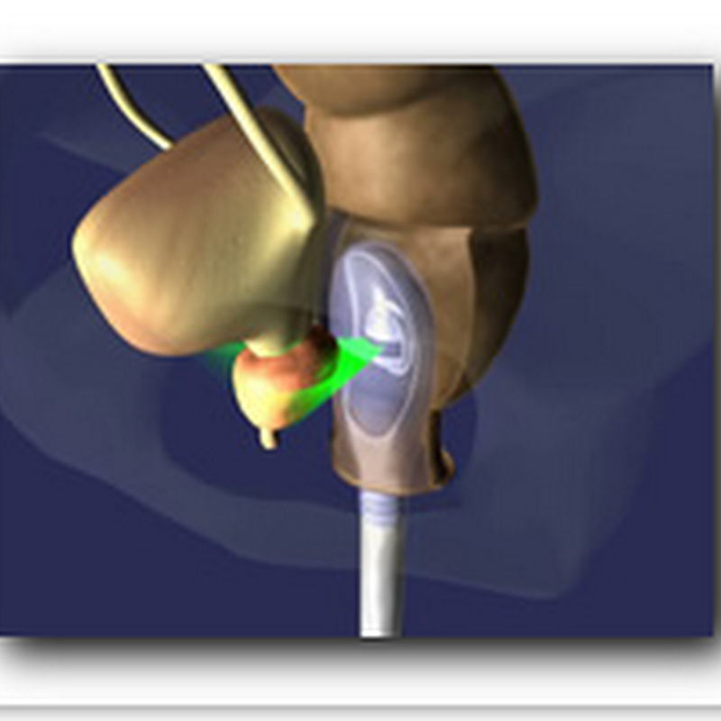 Despite Doubts, Cancer Therapy Draws Patients - HIFU Prostate Cancer Procedure