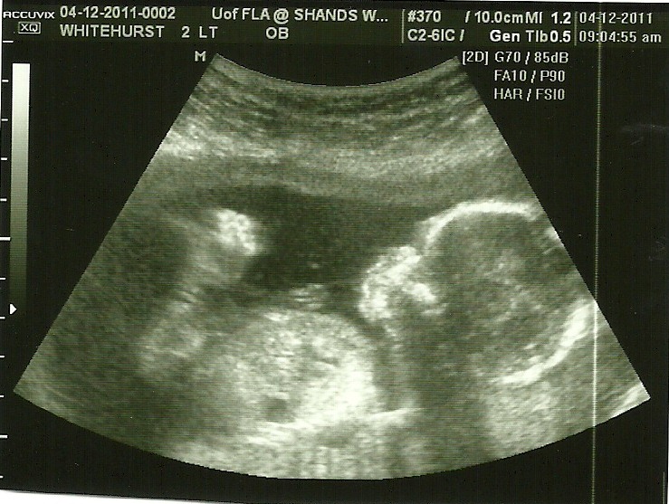 [Baby 2 Profile @ 17 weeks[3].jpg]