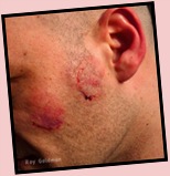 CHEEK.BITE CHEEK.BITE