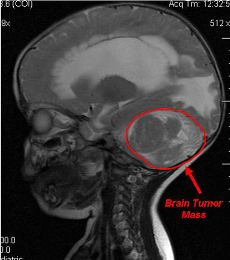 sagittal