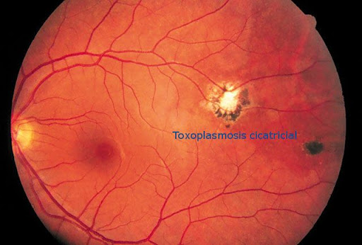 cicatricial A c tax-exempt apr ocular cicatricial pemphigoid cp refers Disease which painful blisters form on Cicatricial