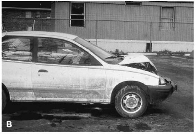  (A) and (B) A 1995 GEO Metro with minor front-end damage consistent with an impact speed of less than 15k.p.h. (9m.p.h.).