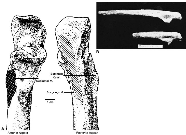  (A) Diagrammatic representation of the proximal end of a human right ulna showing hypertrophy of the supinator and anconeous muscle attachments. This may be a consequence of habitual supination and hyperexten-sion of the fore-arm in spear throwing, ball pitching and use of a slingshot.(B) Hypertrophy of the supinator crest in two human left ulnae from a prehistoric archaeological site at Sarai Nahar Rai, India.