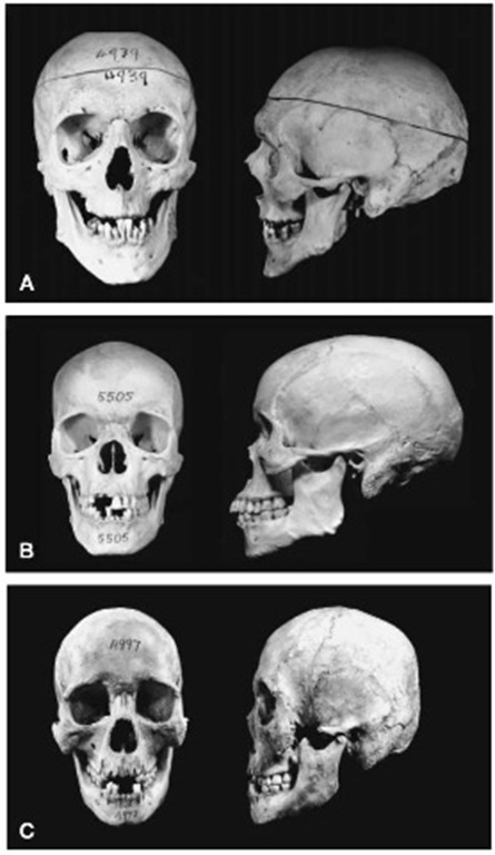 Frontal and profile views of Caucasoid (A), Negroid (B) and Mongoloid (C) skulls.