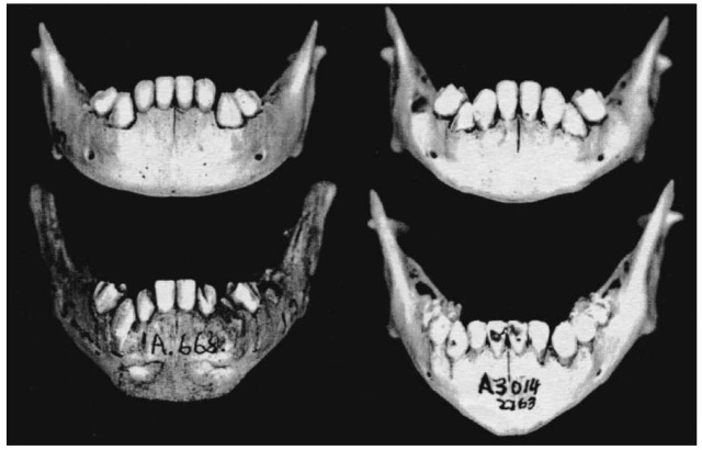 Sex differences in the immature mandible. Female morphology (above) has a rounded corpus shape with a gradual transition from the lateral body to the symphysis. Males (below) show a steep abrupt transition with an angular corpus (not dental arcade) shape