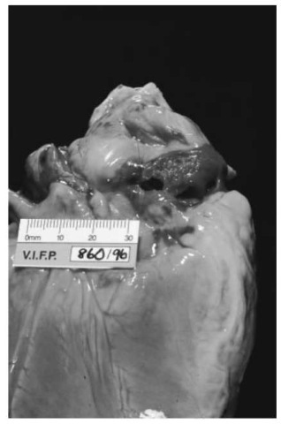 Rupture of the right atrial appendage.