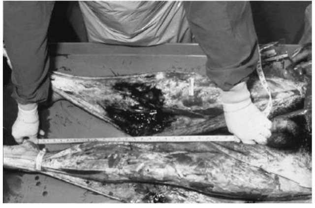 Subcutaneous dissection of the legs to determine accurately the level of impact.