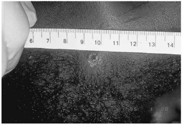 The area of abraided tissue surrounding this gunshot wound of entrance is the 'abrasion collar'. Additional appropriate terms would include: abrasion margin, abrasion rim or abrasion ring.