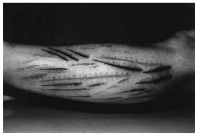 Left forearm of a 21-year-old depressive patient with a schizoid personality disorder and multiple=