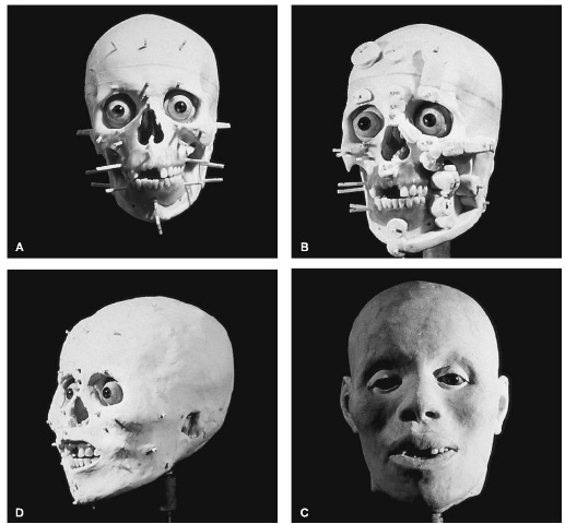 The morphometric method of facial reconstruction: (A) showing depth pegs stuck to skull, at landmarks; (B) islands and graded strips placed between pegs; (C) 'skin' surface smoothed off; (D) finished clay representation;