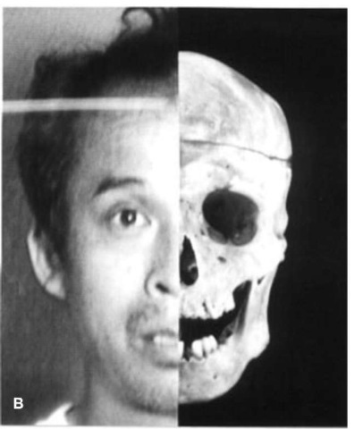 (B) vertical wipe images of the skull and facial photograph. 