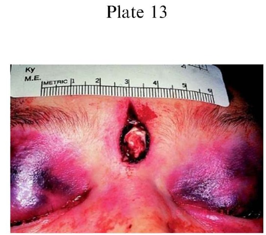 Plate 13 CLINICAL FORENSIC MEDICINE/Evaluation of Gunshot Wounds The contact wound will exhibittriangular shaped tears of the skin. These stellate tears are theresult of injection of hot gases beneath the skin. These gaseswill cause the skin to rip and tear in this characteristic fashion.