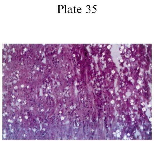 Plate 35 PATHOLOGY/Histopathology Intravenous drug abuse: starch granules and other contaminants at the injection site. H & E; original magnification x 200.
