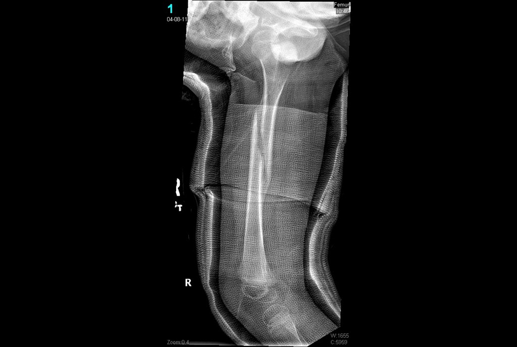 [broken femur cast off 4-8-2011 (1)[7].jpg]