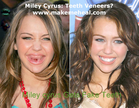 hilary duff teeth. Hilary+duff+teeth+veneers