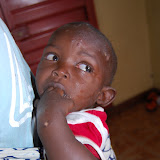 &ndash; Child with chickenpox.......© 2007 NHA photos