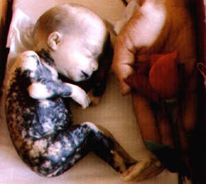 [22weeksaborted_burnedsalineabortion[2].jpg]