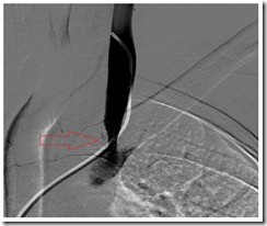 LIJV stenosis 01