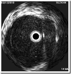 IVUS bad valve 1 IVUS bad valve 1