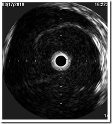 IVUS bad valve 2 IVUS bad valve 2