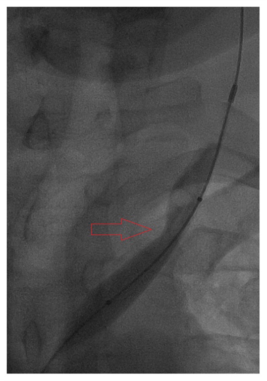 [LIJV partial inflate 01[5].jpg]