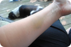 Wicked bruise