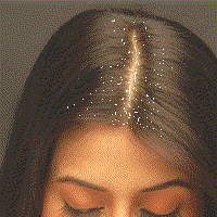 Image Dimension: 200x200 what is dandruff?