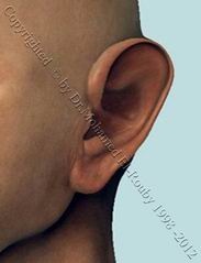 otoplasty otoplasty