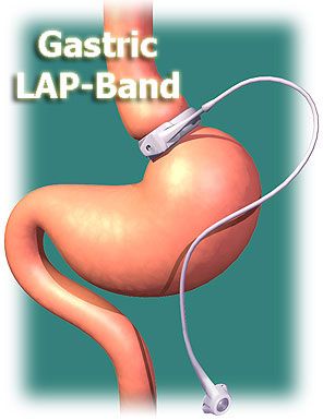 gastric lap band gastric lap band