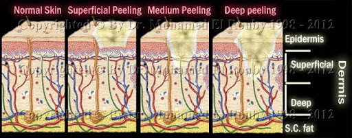 types of chemical descascar types of chemical descascar