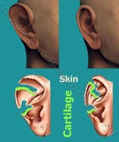 idea of ear reshaping idea of ear reshaping