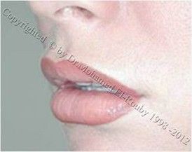 lip filler lip filler