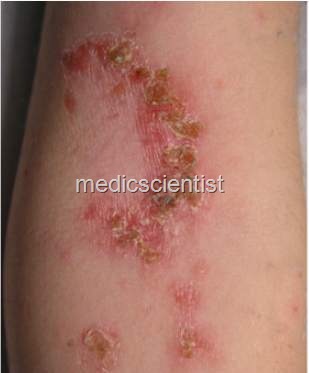 [Streptococci Bacterial Infections 4[2].jpg]