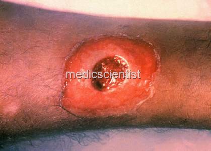 [DIPHTHERIA skin[2].jpg]
