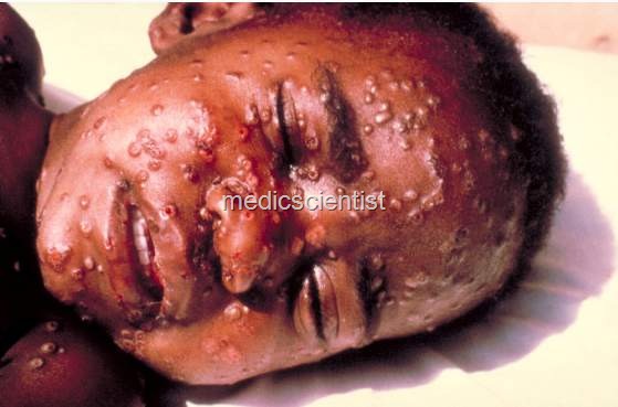 [SMALLPOX UYH[2].jpg]